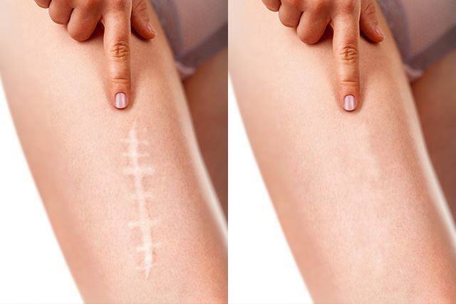 Dehnungsstreifen Camouflage München - Natürliche Kaschierung