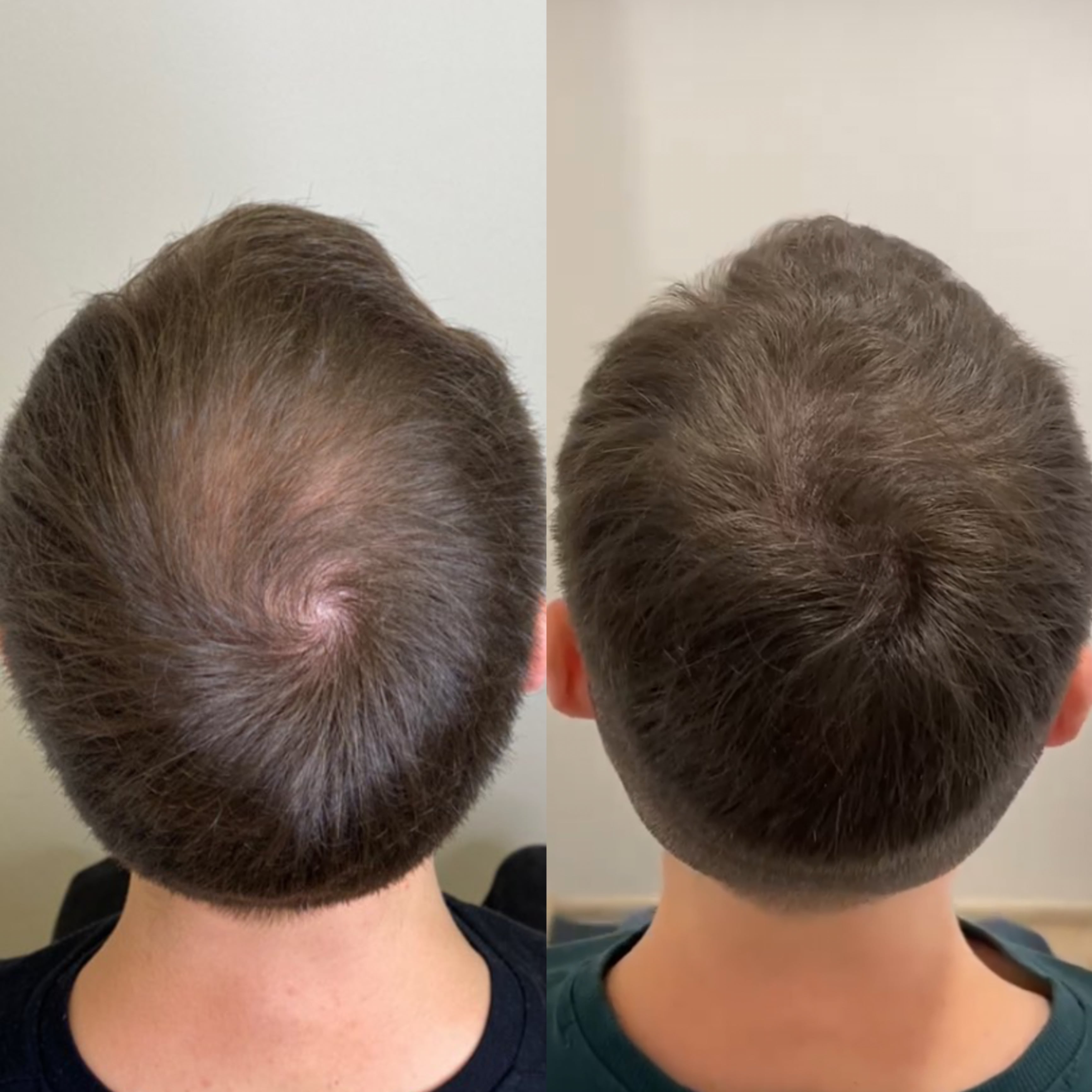 Kopfhaut Pigmentierung München - SMP Vorher Nachher Ergebnis